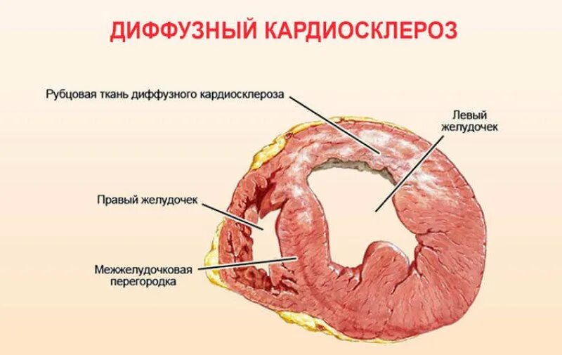 Инфаркт миокарда кардиосклероз. Крупноочаговый кардиосклероз патанатомия. постинфарктный крупноочаговый кардиосклероз осложнения. рубцы миокарда макропрепарат. диффузный атеросклеротический кардиосклероз.