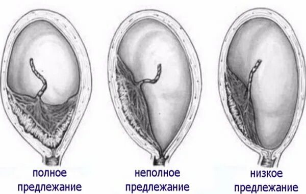 Предлежание плаценты операция. Полное предлежание плаценты узи. полное центральное предлежание плаценты. краевое предлежание плаценты на узи. краевое предлежание хориона.