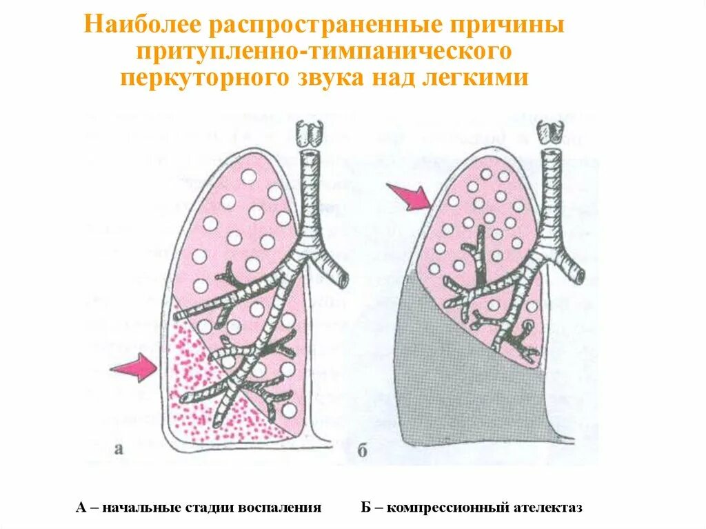 Компрессионный ателектаз аускультация. Компрессионный ателектаз лёгкого. Компрессионй аттелектаз аускульауия. Обтурационный ателектаз. Обтурационный ателектаз легкого