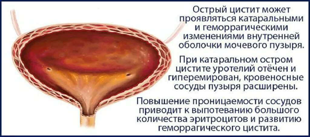 После мочевого. Острый гематурический цистит. Острый катаральный цистит. Острый геморрагический цистит. Воспаление слизистой мочевого пузыря.