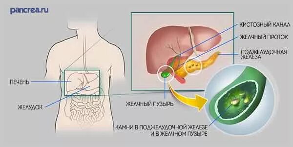 Камни в поджелудочная железа симптомы лечение