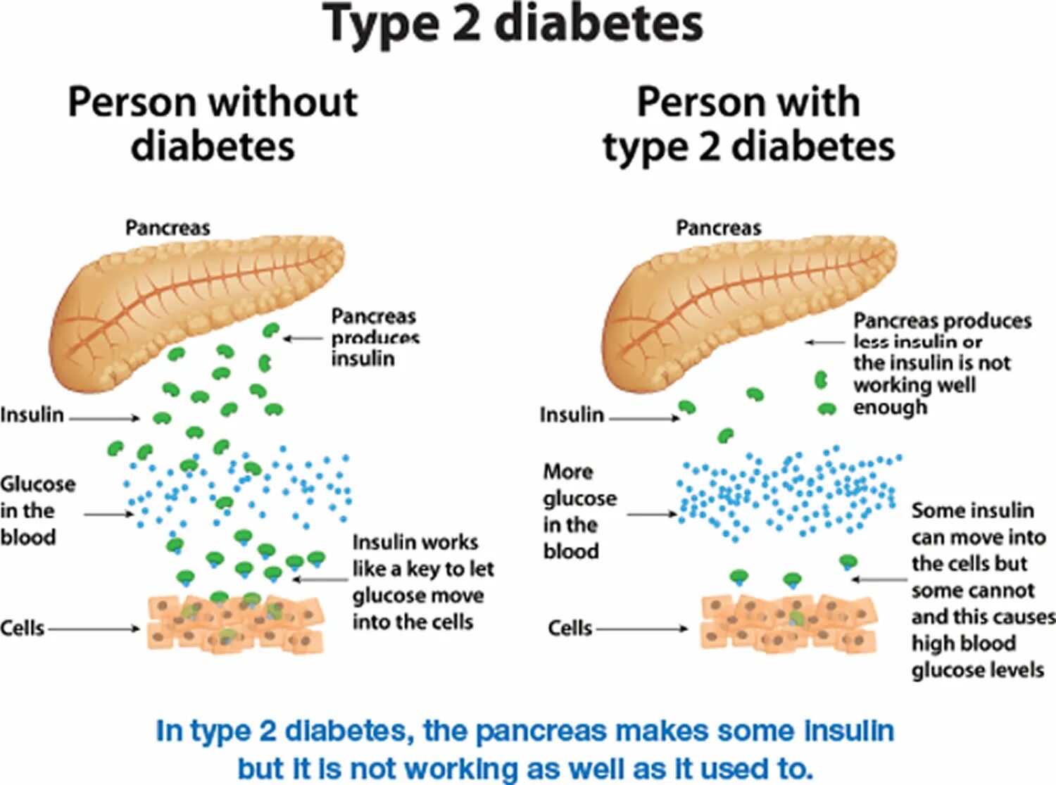 Type 2 Diabetes. Diabetes mellitus. Insulin Types. Клетки вырабатывающие инсулин. Sites type 1