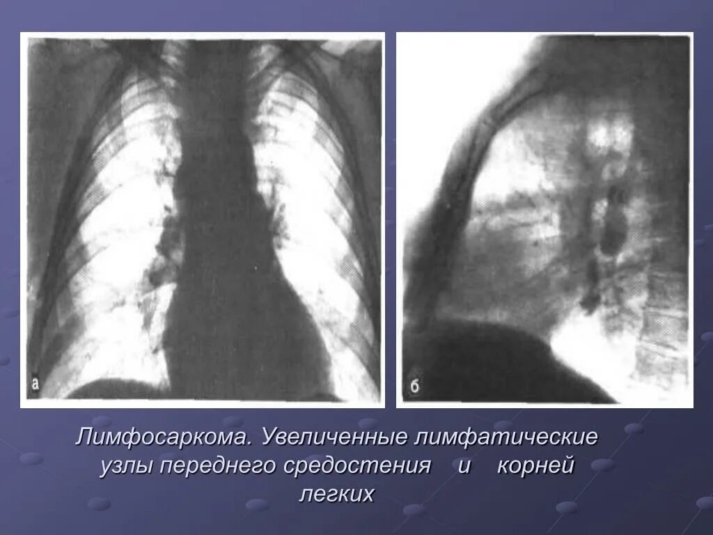 Лимфосаркомапериферический лимфоузлов. Нодулярная лимфосаркома. Лимфоузел в легком причина