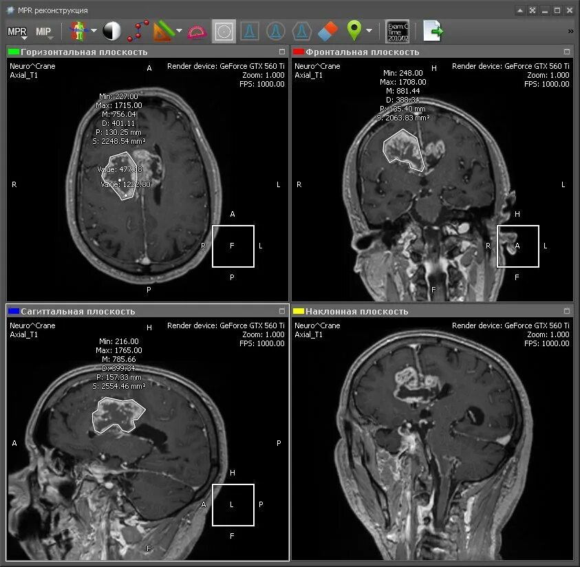 MPR реконструкция кт. Мрт в формате Dicom что это такое. Мультипланарная реконструкция мрт. Мультипланарная реконструкция кт.