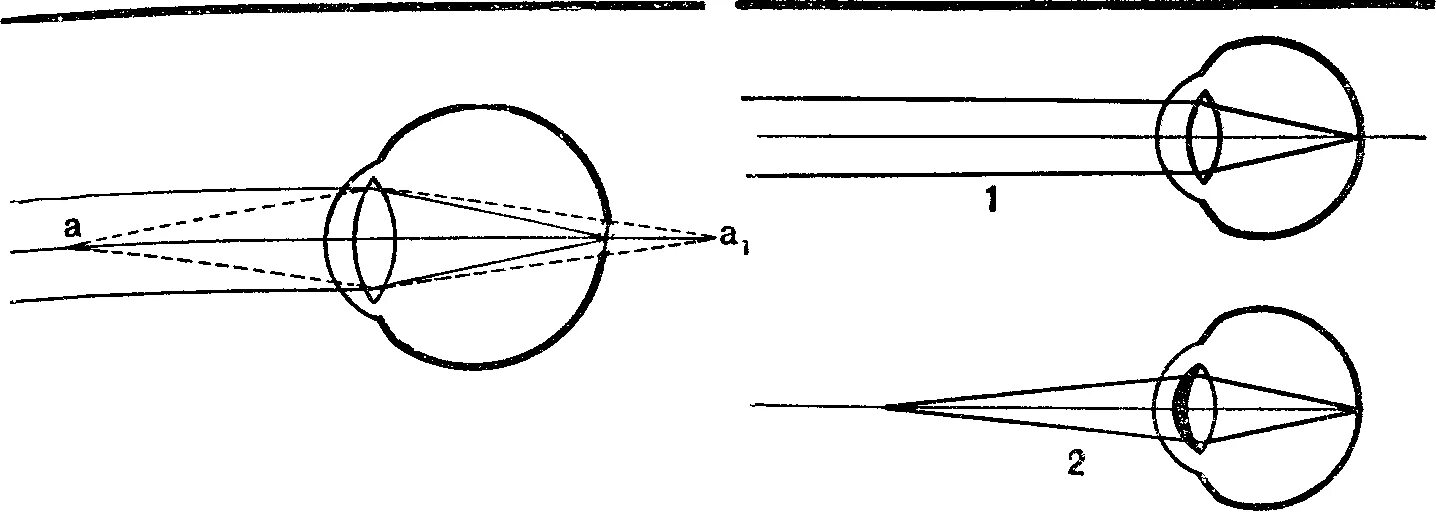 Ход лучей близорукость и дальнозоркость. Схема глаза при близорукости и дальнозоркости. Близорукость и дальнозоркость схема физика. Близорукость и дальнозоркость схема глаза. Нормальный глаз схема