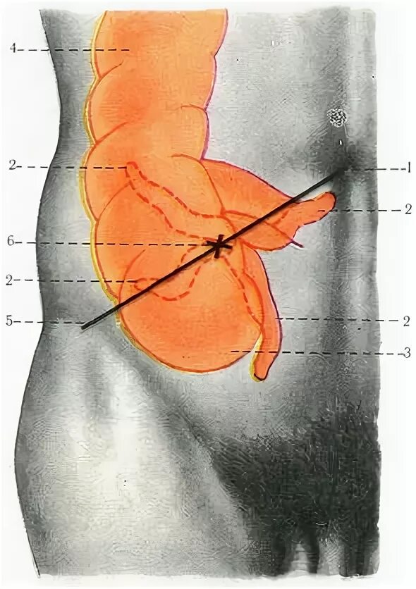 анатомия отделов стенки толстой кишки. слепая кишка голотопия скелетотопия синтопия. ретроцекальная аппендэктомия. слепая кишка в брюшной полости расположена. область проекции слепой кишки на переднюю брюшную стенку.