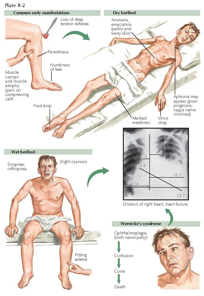 Полиневрит (болезнь «бери-бери»). Бери-бери болезнь фото. При недостатке заболевание бери бери