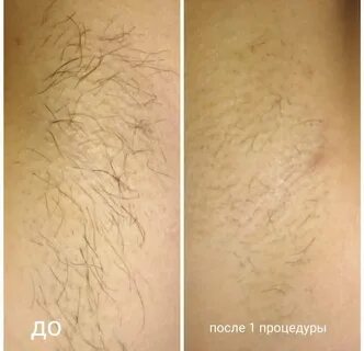 Электроэпиляция барнаул