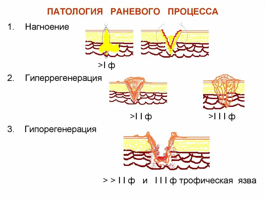 Этапы заживления ран. Фазы заживления РАН схема. Заживление РАН – раневой процесс. Фазы раневого процесса заживления РАН. Процесс заживления РАН схема.