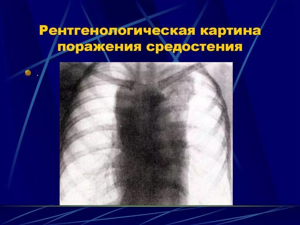 Аденопатия. Лимфогранулематоз средостения рентген. Медиастинальная лимфаденопатия рентген. Саркоидоз средостения рентген. Медиастал ная лимфоденопатия.