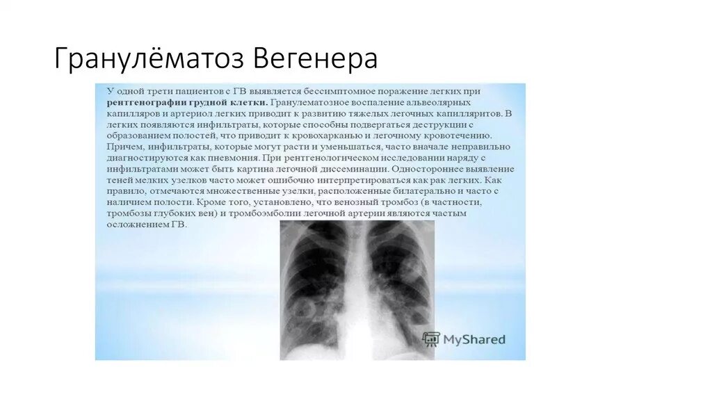 Гранулематоз лечение. @evgehka10041990:гранулематоз вегенера.