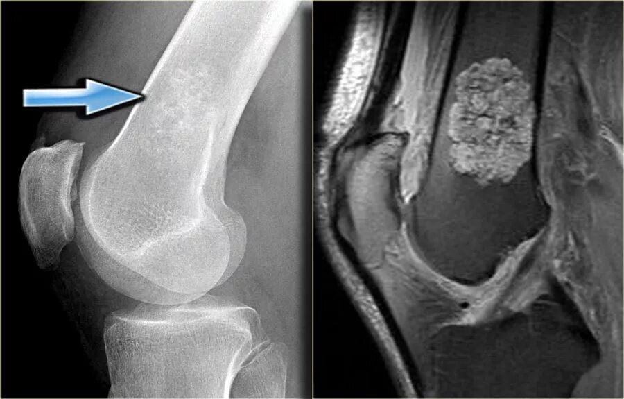 Опухоль кости энхондрома. Хондросаркома бедренной кости кт. Энхондрома бедренной кости кт. Эностоз бедренной кости рентген. Участки отека костного мозга