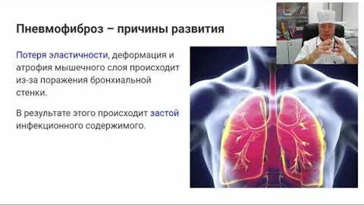 Постпневмонический пневмосклероз. Периспондилофитарный пневмофиброз. Пневмосклероз этиология. Очаговый пневмосклероз рентген. Базальный пневмосклероз на рентгене.