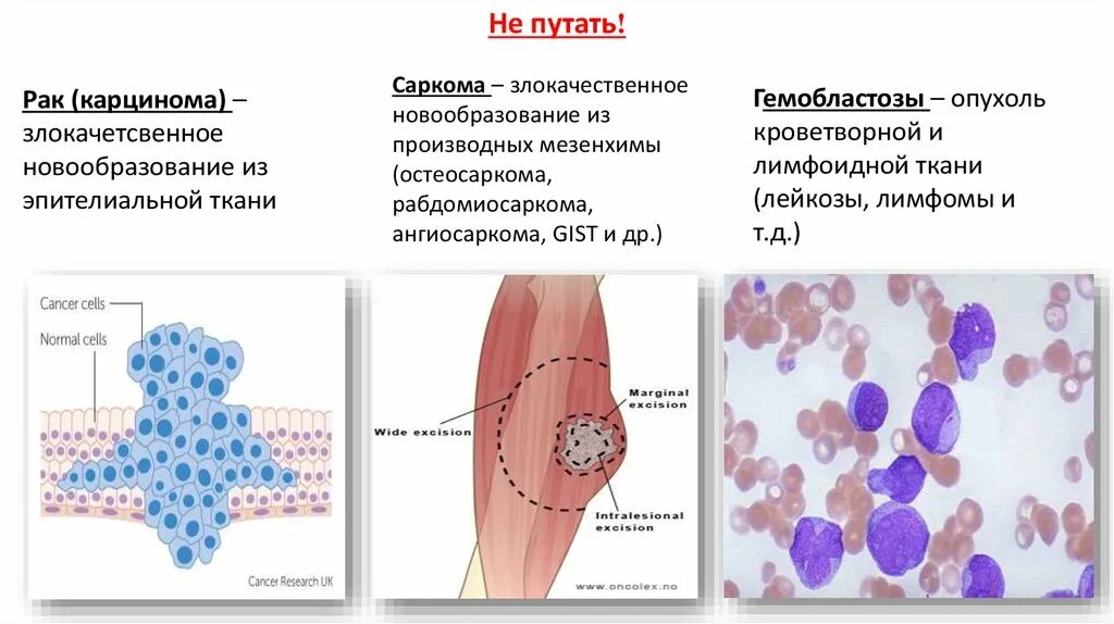 Чем отличается саркома. Злокачественные новообразования лимфоидной ткани. Злокачественные опухоли кроветворной ткани. Злокачественные опухоли схема. Злокачественная опухоль эпителиальной ткани.