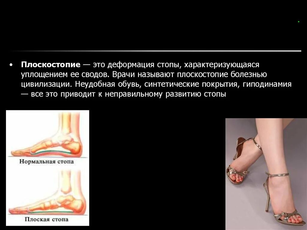 Плоскостопие на одной ноге берут ли. Плоскостопие это хроническое заболевание. Осложненное плоскостопие. Плоскостопие формулировка диагноза. Осложнения плоскостопия.
