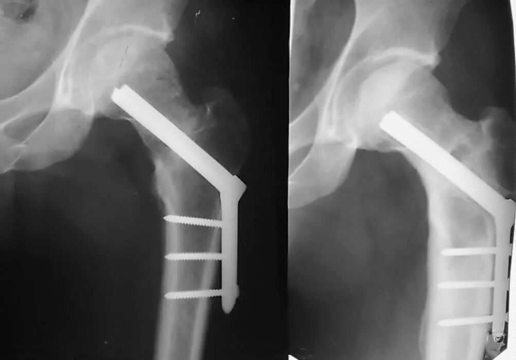 Оскольчатый перелом шейки бедра рентген. Чрезвертельный перелом остеосинтез. Остеосинтез шейки бедра рентген. Остеосинтез бедра пластиной рентген. Перелом бедра лечение без операции