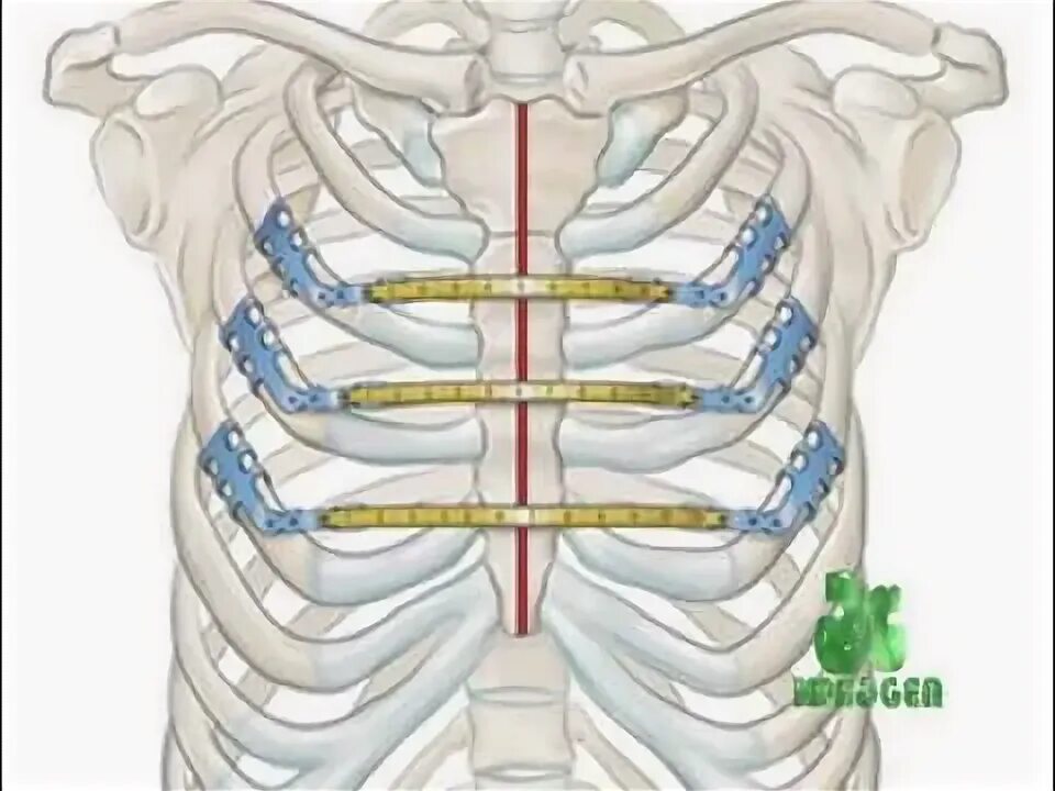 Бандаж при переломе ребер. Перелом ребер и перелом грудины. Человеческие ребра. Перелом ребер грудной клетки. Неосложненный перелом ребра.