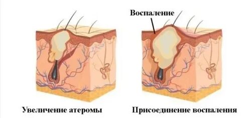 Снять воспаление кисты