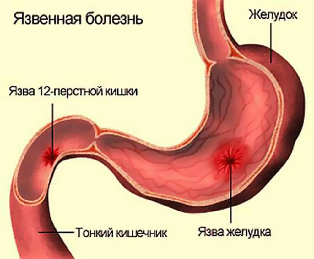 Язвенная болезнь желудка и 12 перстной. Язва желудка и 12 перстной кишки. Язвенная болезнь болезнь желудка и 12 перстной кишки. Язвенная болезнь 12 перстной кишки. Размеры язвы желудка