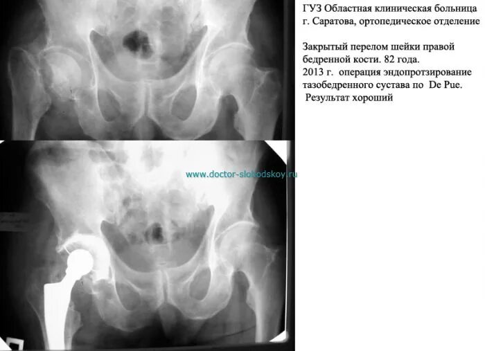 Эндопротезирование тазобедренного сустава. Схема замены тазобедренного сустава. Тотальное эндопротезирование тазобедренного сустава ход операции. Больничный лист при эндопротезировании тазобедренного сустава.