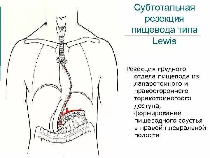 Операция Добромыслова-Торека пищевод. Схема операций пищевода. Трансторакальная субтотальная резекция пищевода. Пластика пищевода желудком операция Льюиса. Операция пищевода лечение