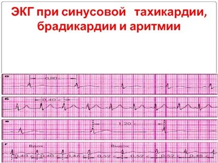Нерегулярный синусовый