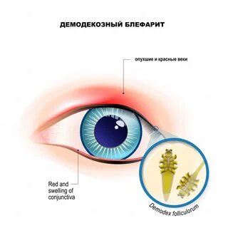 Психосоматика конъюнктивита
