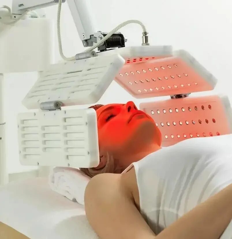 фотодинамическая косметология отзывы. фотодинамическая терапия heleo4. фдт в косметологии до и после. фотодинамическая косметология отзывы. фотодинамическое омоложение кожи.