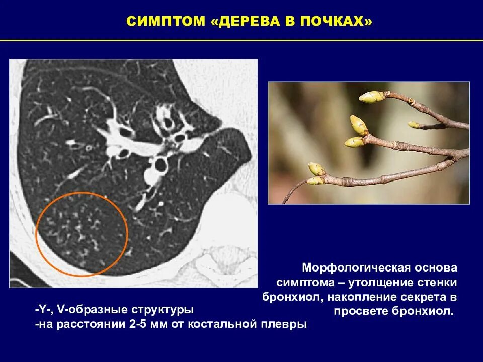 Дерева в почках в легких кт. Бронхиолит кт дерево в почках. Симптом дерева в почках на кт. Дерево в почках на кт.