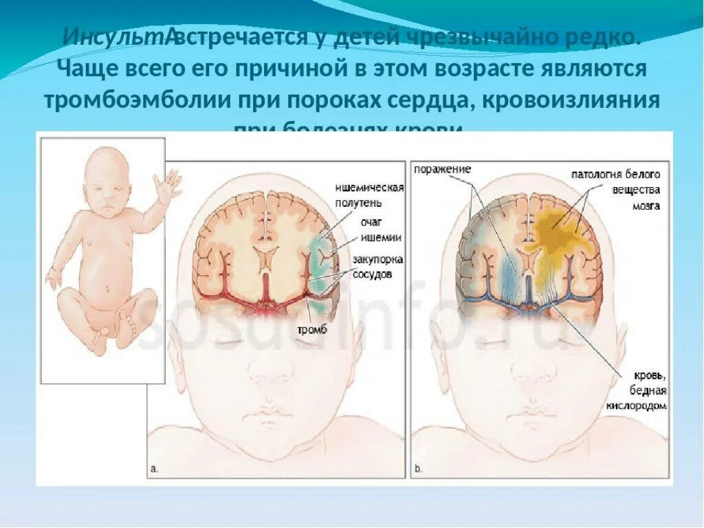 Гипоксия мозга у ребенка. Энцефалопатия у новорожденных. Энцефалопатия головного мозга у новорожденного. Кровоснабжение головного мозга новорожденного. Энцефалопатия у грудничка.