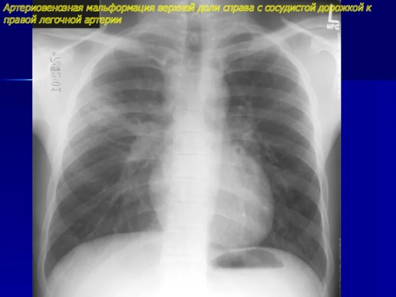 Сосудистая аномалия. Сосудистая мальформация легких на кт. Гемосидероз легких рентген. Артериовенозная мальформация в легких на кт. Сосудистая мальформация легких рентген.