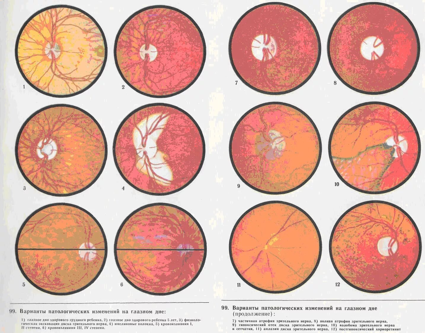 Миелиновые волокна сетчатки. Офтальмоскопия глазного дна норма. Топография глазного дна. Изменение на глазном дне