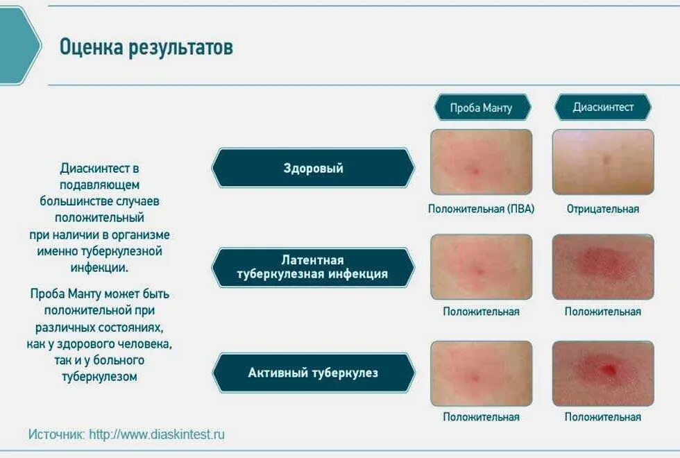 Какая реакция должна. Реакция на туберкулез диаскинтест. Диаскинтест оценка реакции. Положительная манту папула.