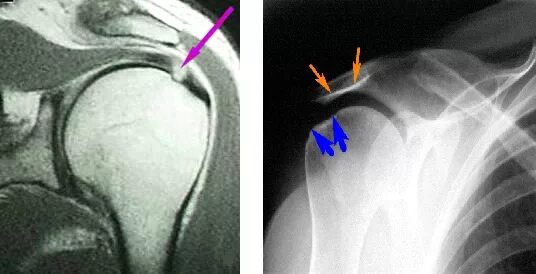 Ротаторная манжета плечевого сустава разрыв. Ротаторная манжета плечевого сустава мрт. Повреждение вращательной манжеты плечевого сустава на рентгене. Повреждение ротаторной манжеты плечевого сустава рентген. Разрыв плечевого сустава симптомы