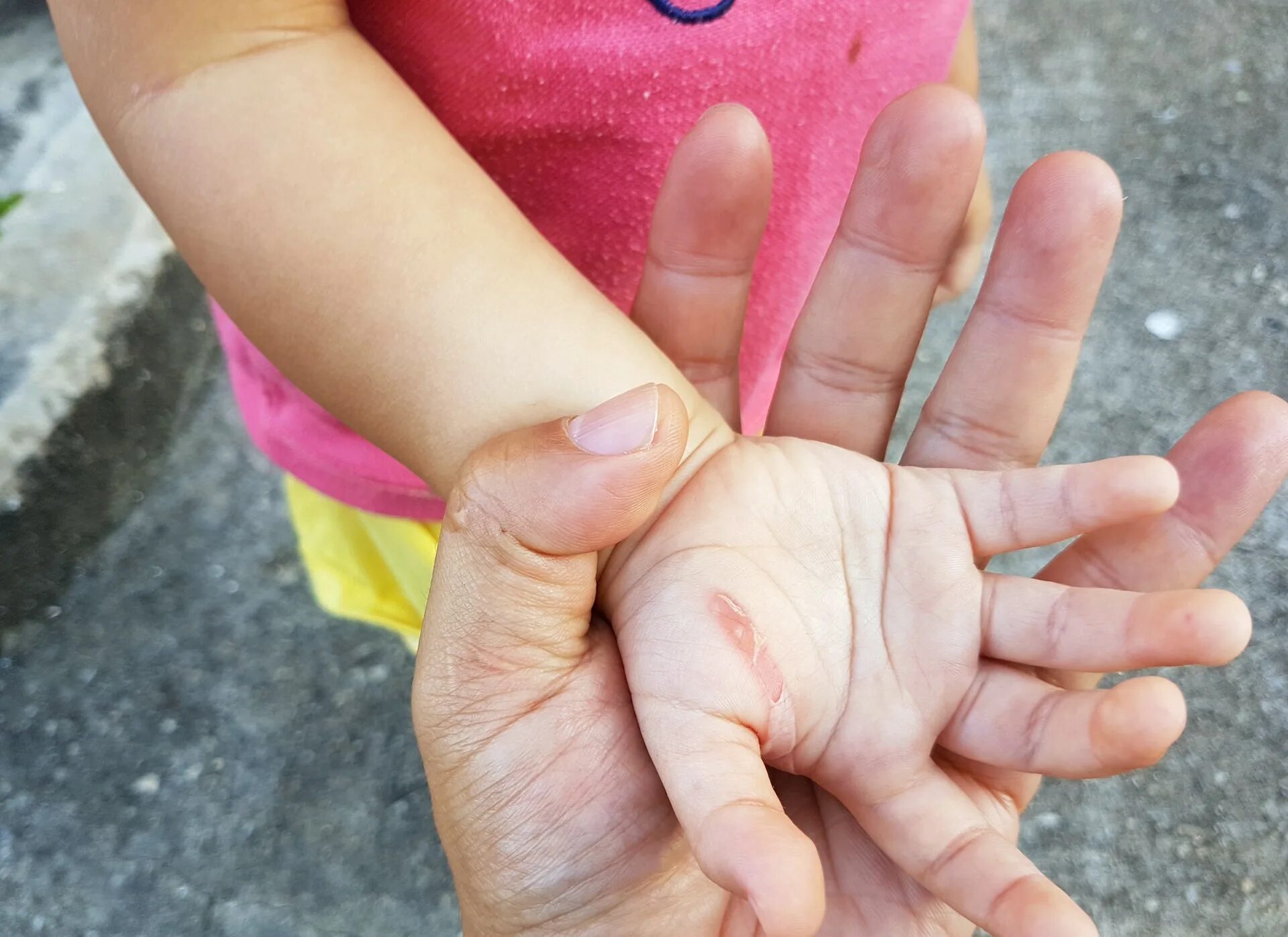 Дети под большим пальцем. Массаж стоп для детей. Подошвенные бородавки-шипицы. Ручка для детей. Дети под большим пальцем.