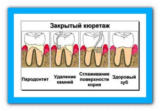 Остановить кровотечение удаления зуба. Сгусток крови в лунке зуба. Кровяной сгусток в лунке зуба. Лунка удаленного зуба мудрости. Сгусток в удаленном зубе.