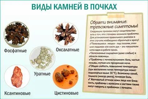 Фосфатные камни в почках