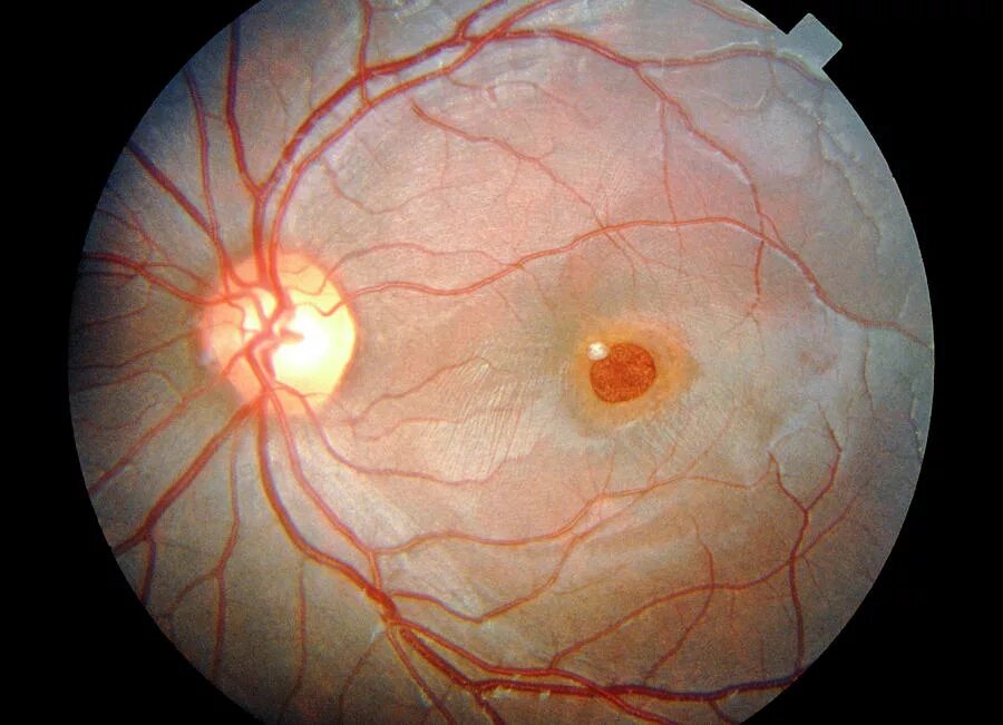 Офтальмоскопия глазного дна. Офтальмоскопия сетчатки. Эпиретинальный фиброз офтальмоскопия. Замена сетчатки