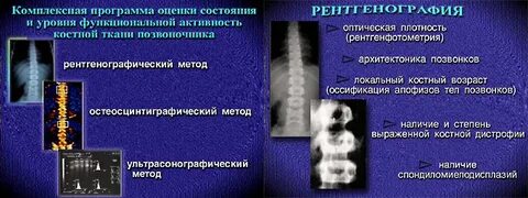 Турнера сколиоз