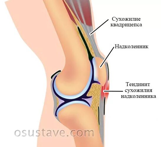 Тендинопатия сухожилия коленного сустава. Тендиноз собственной связи надколенника. Воспаление сухожилия надколенника. Повреждение связки надколенника симптомы.