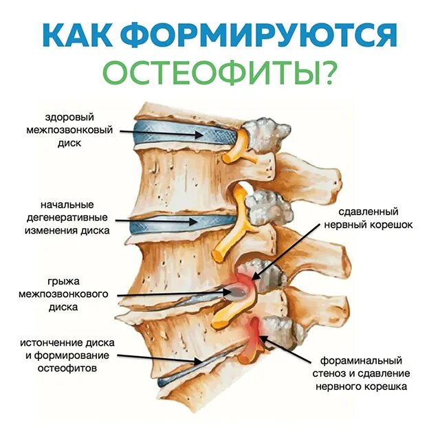 Остеофит симптомы