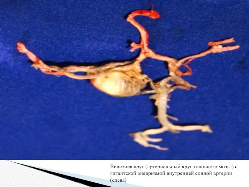 Аневризма сонной артерии что это. Фузиформная аневризма ВСА. Супраклиноидная аневризма. Аневризма левой ВСА головного мозга. Фузиформная аневризма супраклиноидного отдела ВСА.