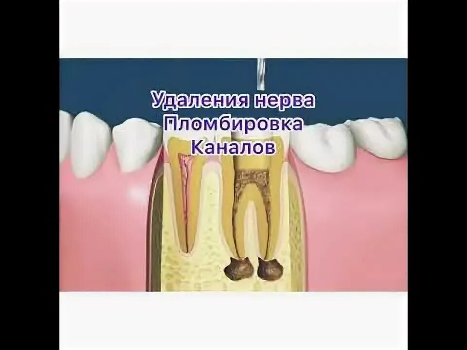Удаление нервов в зубе и пломбирование. Удаление нервов в зубе и пломбирование