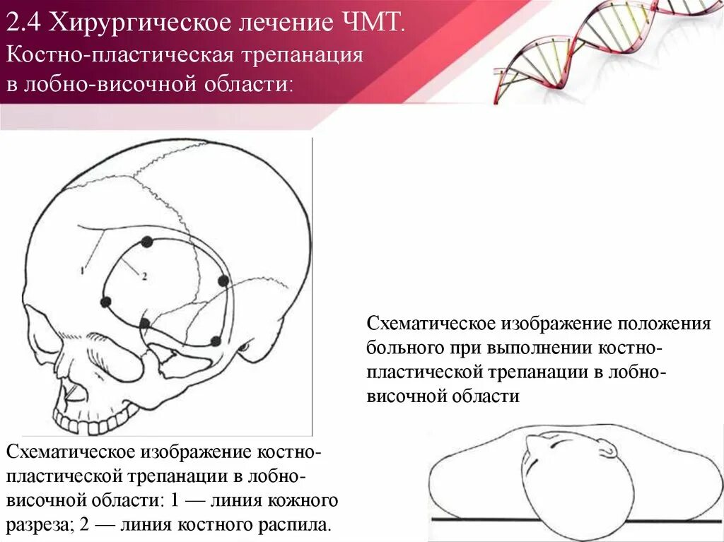 Черепно мозговые операции. Декомпрессионная и костно пластическая Трепанация. Костно-пластическая и Декомпрессивная Трепанация черепа. Положение пациента при трепанации черепа. Трепанация черепа височная область.