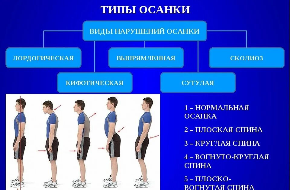 Диагностика нарушения осанки. Типы осанки. нарушение осанки. виды нарушения осанки. названия нарушений осанки.