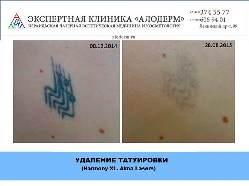 Как выглядит тату после удаления лазером. Как выглядит тату после удаления лазером