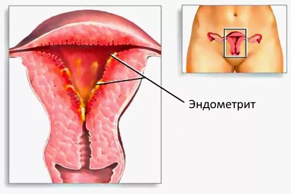 Воспаление внутренней оболочки матки. Послеродовый метроэндометрит. Острый гонорейный эндометрит. Острый послеродовой эндометрит. Эндомиометрит (метроэндометрит).