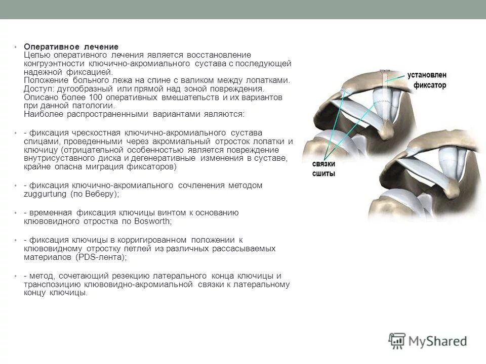 Разрыв ключично акромиального сочленения код мкб. Рентген ключичного сустава это. Разрыв ключично акромиального сочленения код мкб. Разрыв акромиально-ключичного сочленения типы. Разрыв ключично акромиального сочленения код мкб.