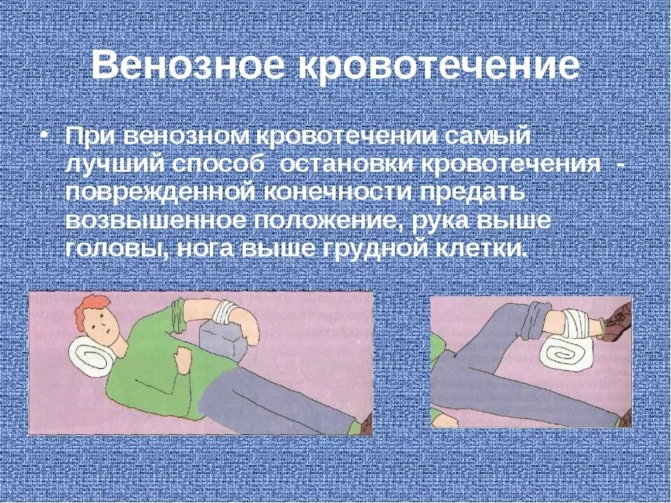 Эффективный и доступный метод остановки венозного