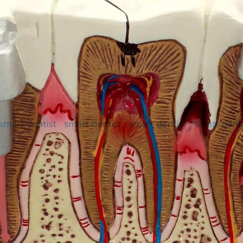 Good Quality Caries Tooth Model Dentist Patient Communication Anatomy Model Dent